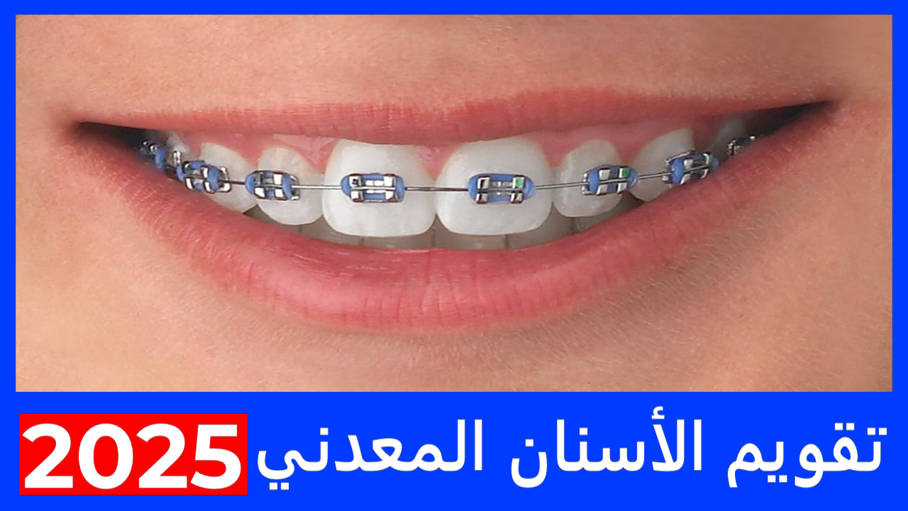 تقويم الأسنان المعدني