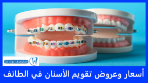 أسعار تقويم الأسنان في الطائف