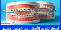 أسعار تقويم الأسنان في خميس مشيط 2025 احسن العروض الموجودة