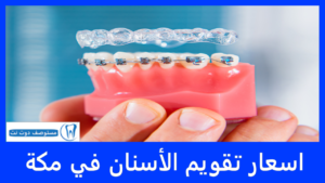 اسعار تقويم الأسنان في مكة 2025 - ارخص تقويم اسنان في مكة