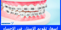 اسعار تقويم الاسنان في الاحساء 2025 + افضل العروض