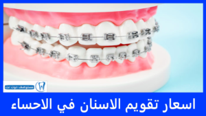 اسعار تقويم الاسنان في الاحساء
