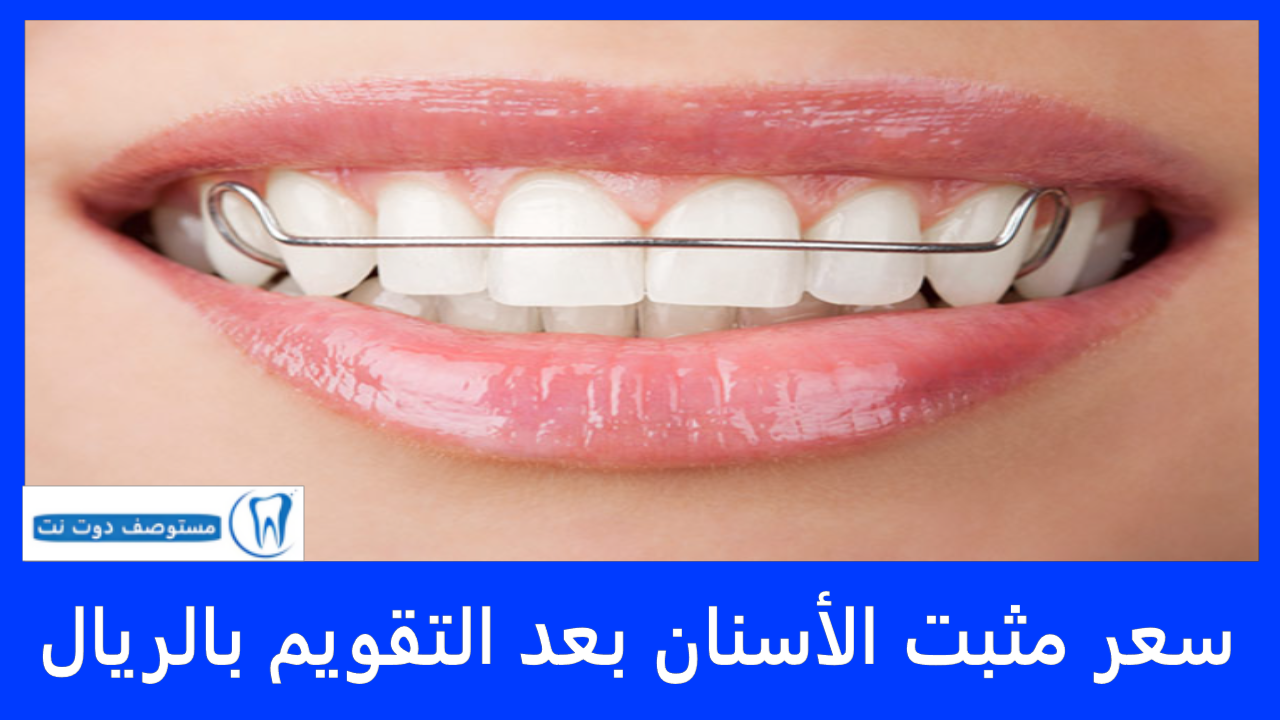 سعر مثبت الأسنان بعد التقويم بالريال