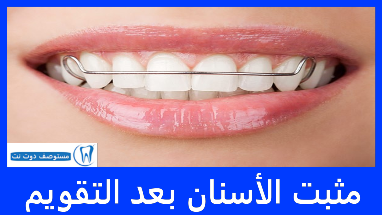 مثبت الأسنان بعد التقويم - فوائده وانواعه وكم مدة استخدامه؟