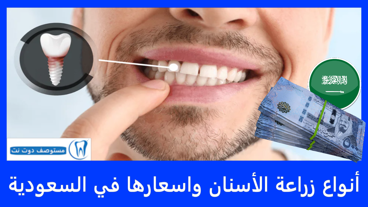 أنواع زراعة الأسنان واسعارها في السعودية