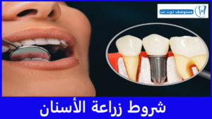 شروط زراعة الأسنان
