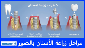 مراحل زراعة الأسنان بالصور