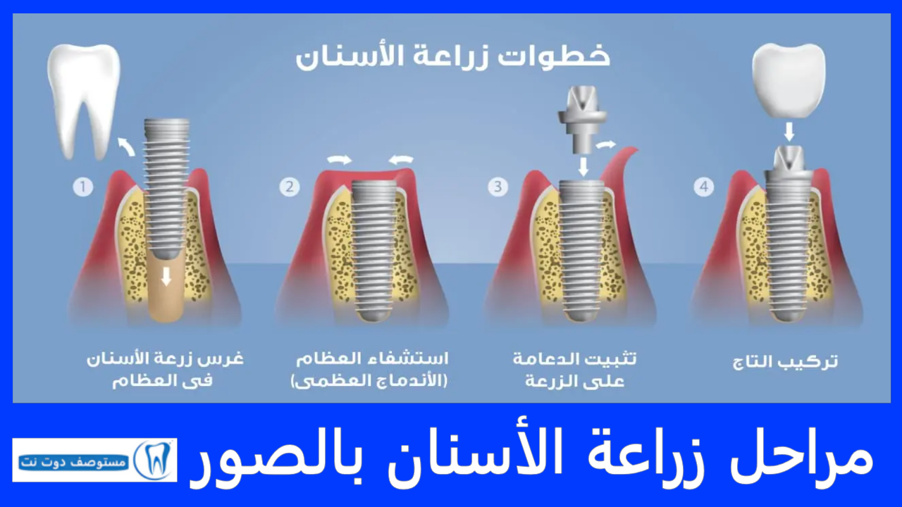 مراحل زراعة الأسنان بالصور