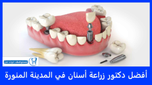 أفضل دكتور زراعة أسنان في المدينة المنورة