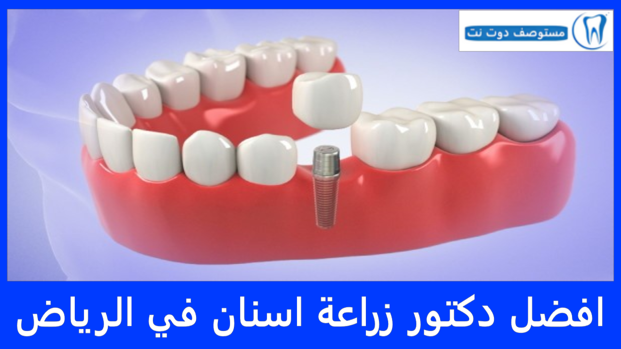افضل دكتور زراعة اسنان في الرياض