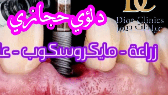دكتور لؤي حجازي – زراعة أسنان في الطائف بخبرة متقدمة وتقنيات حديثة