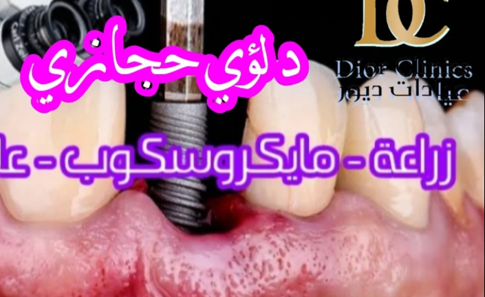 دكتور لؤي حجازي – زراعة أسنان في الطائف بخبرة متقدمة وتقنيات حديثة
