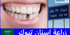 أفضل 6 أماكن زراعة اسنان تبوك من حيث الجودة والسعر