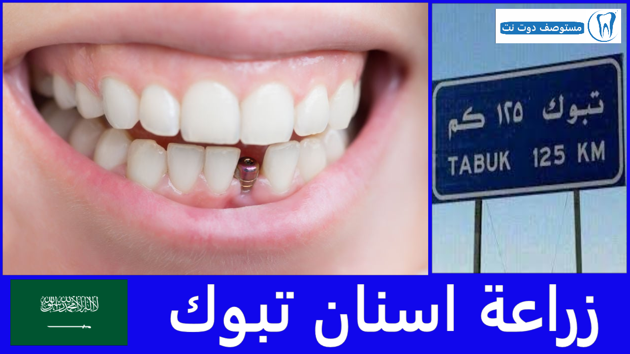 أفضل 6 أماكن زراعة اسنان تبوك من حيث الجودة والسعر