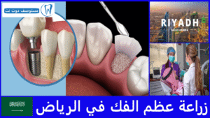 زراعة عظم الفك في الرياض