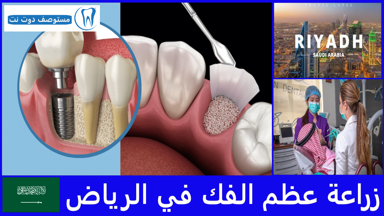 زراعة عظم الفك في الرياض