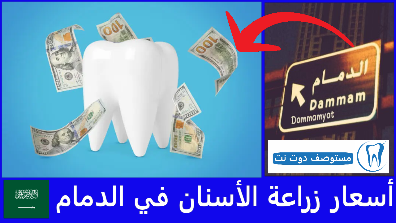 أسعار زراعة الأسنان في الدمام