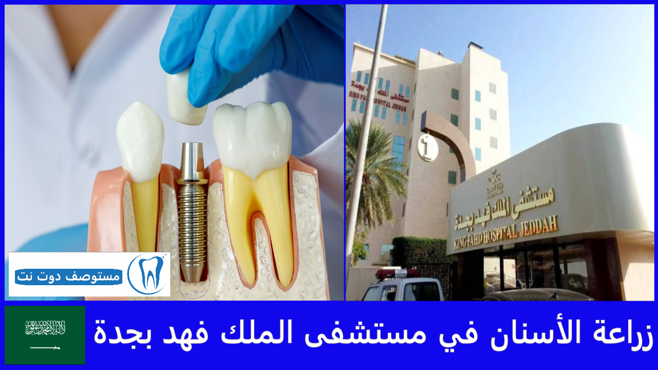 زراعة الأسنان في مستشفى الملك فهد بجدة