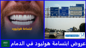عروض ابتسامة هوليود في الدمام