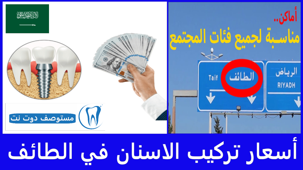 أسعار تركيب الاسنان في الطائف