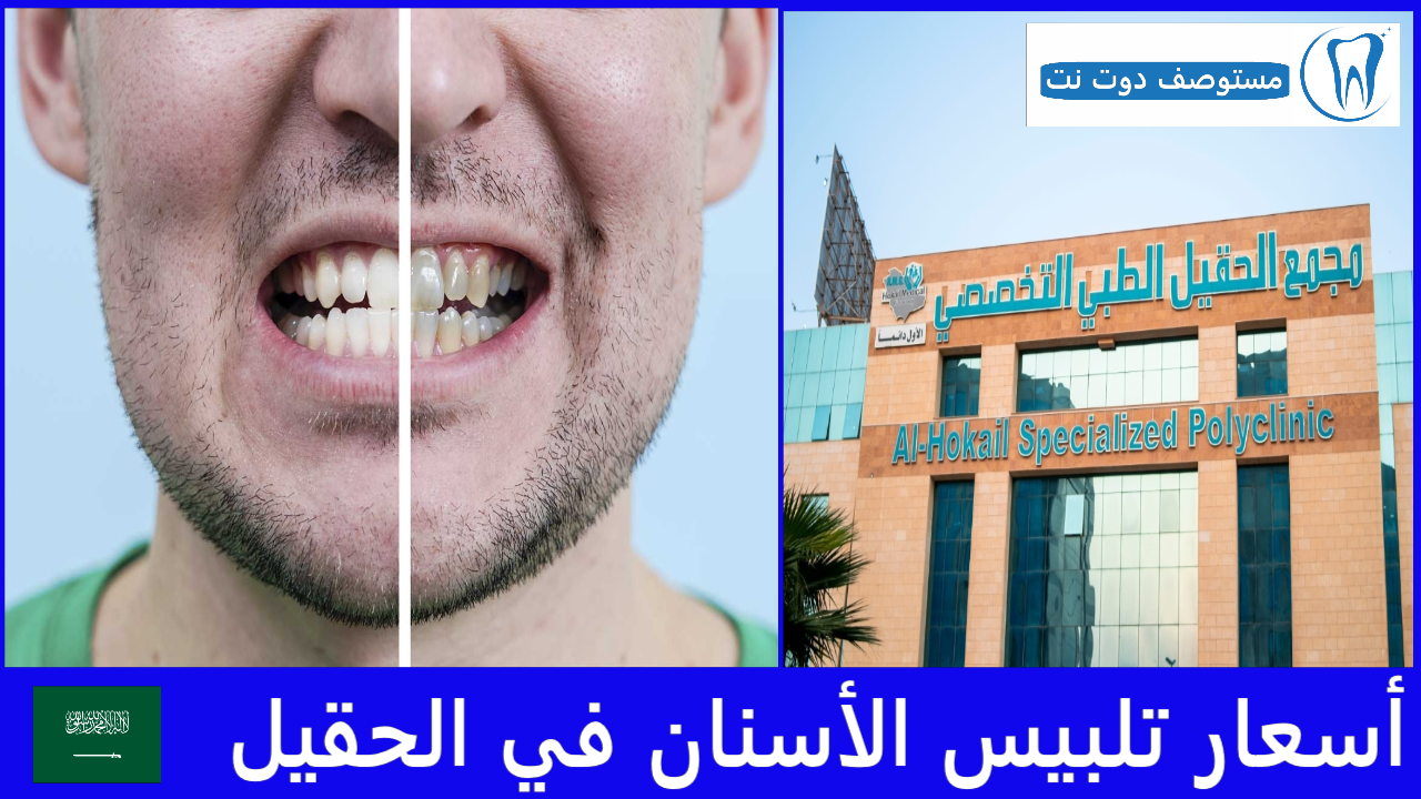 أسعار تلبيس الأسنان في الحقيل