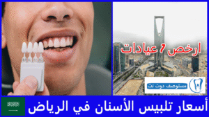 أسعار تلبيس الأسنان في الرياض