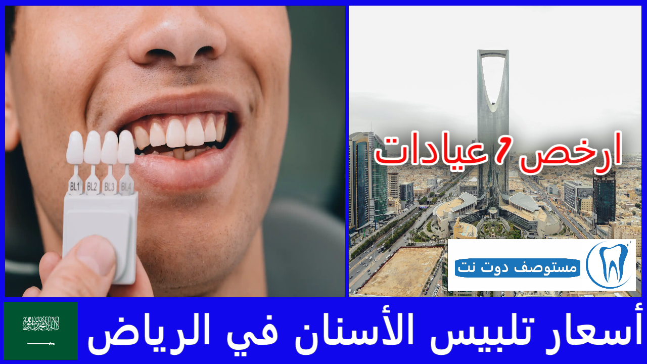 أسعار تلبيس الأسنان في الرياض