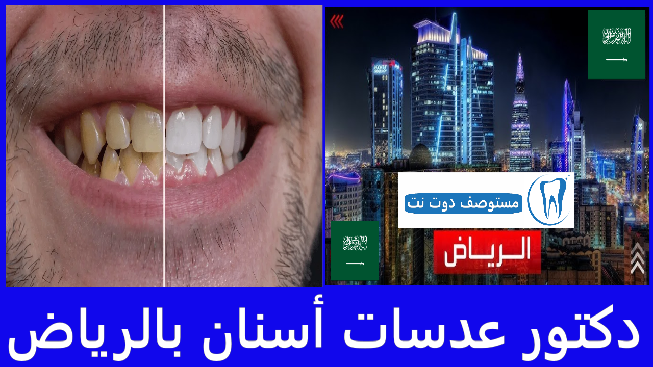 أفضل دكتور عدسات أسنان بالرياض