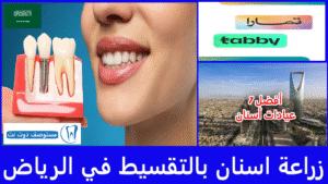زراعة اسنان بالتقسيط في الرياض