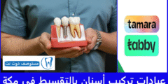 قائمة 10 عيادات تركيب أسنان بالتقسيط في مكة مجربة