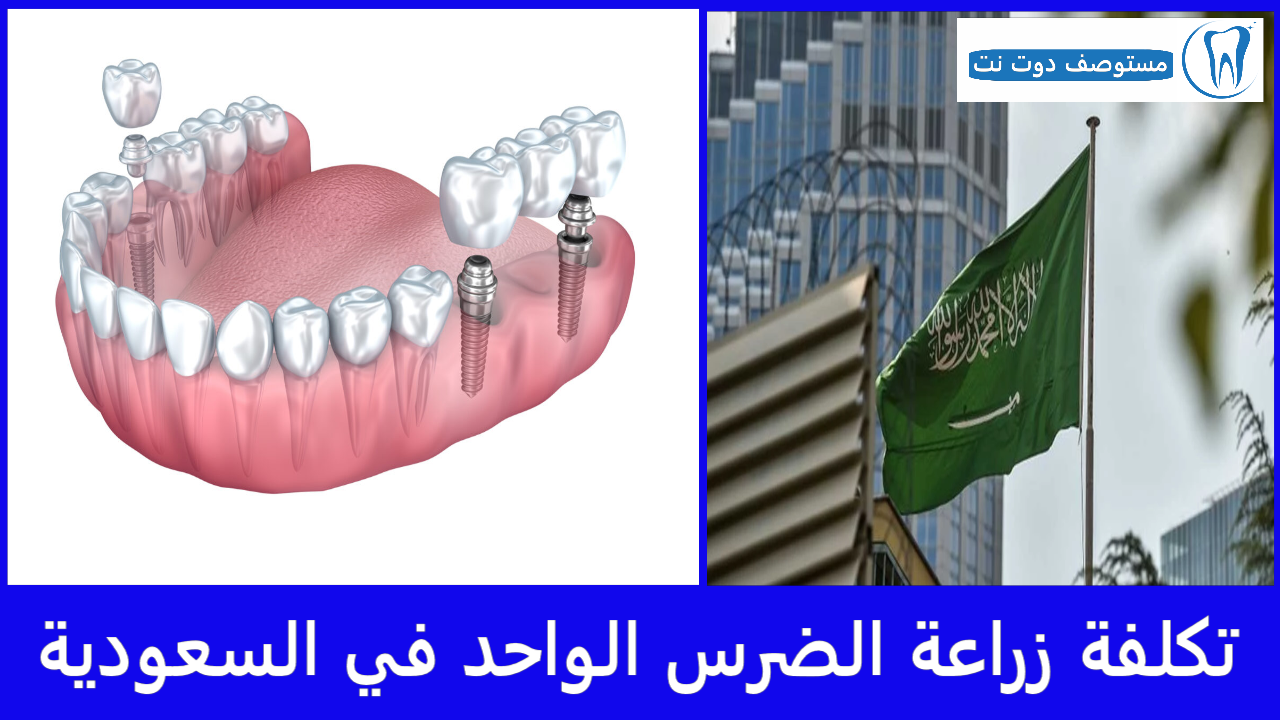 تكلفة زراعة الضرس الواحد في السعودية