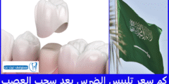 كم سعر تلبيس الضرس بعد سحب العصب في السعودية؟