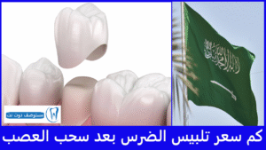 كم سعر تلبيس الضرس بعد سحب العصب في السعودية؟