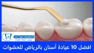 افضل 10 عيادة أسنان بالرياض للحشوات
